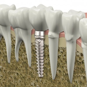 Very high resolution 3d rendering of a dental implant