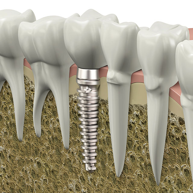 「第二の永久歯」インプラント治療
